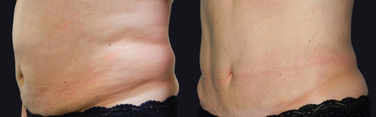 Coolsculpting Before & After Gallery - Patient 177905926 - Image 1