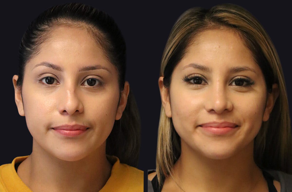Rhinoplasty Before & After Gallery - Patient 177905934 - Image 8