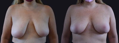 Breast Lift Before & After Gallery - Patient 177905933 - Image 1