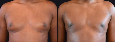 Male Breast Reduction (Gynecomastia) Before & After Gallery - Patient 177905929 - Image 1
