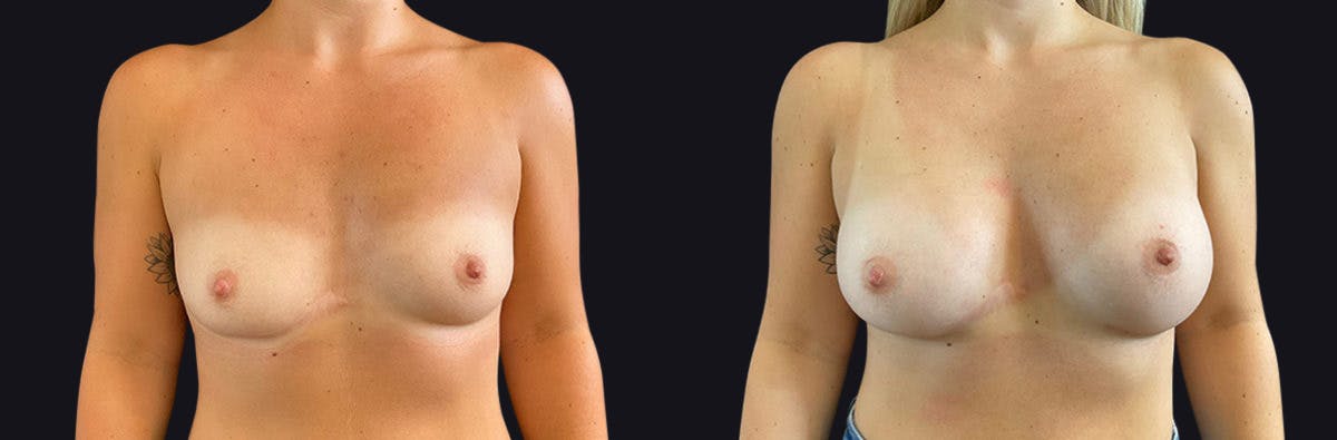 Breast Augmentation Before & After Gallery - Patient 177905931 - Image 1