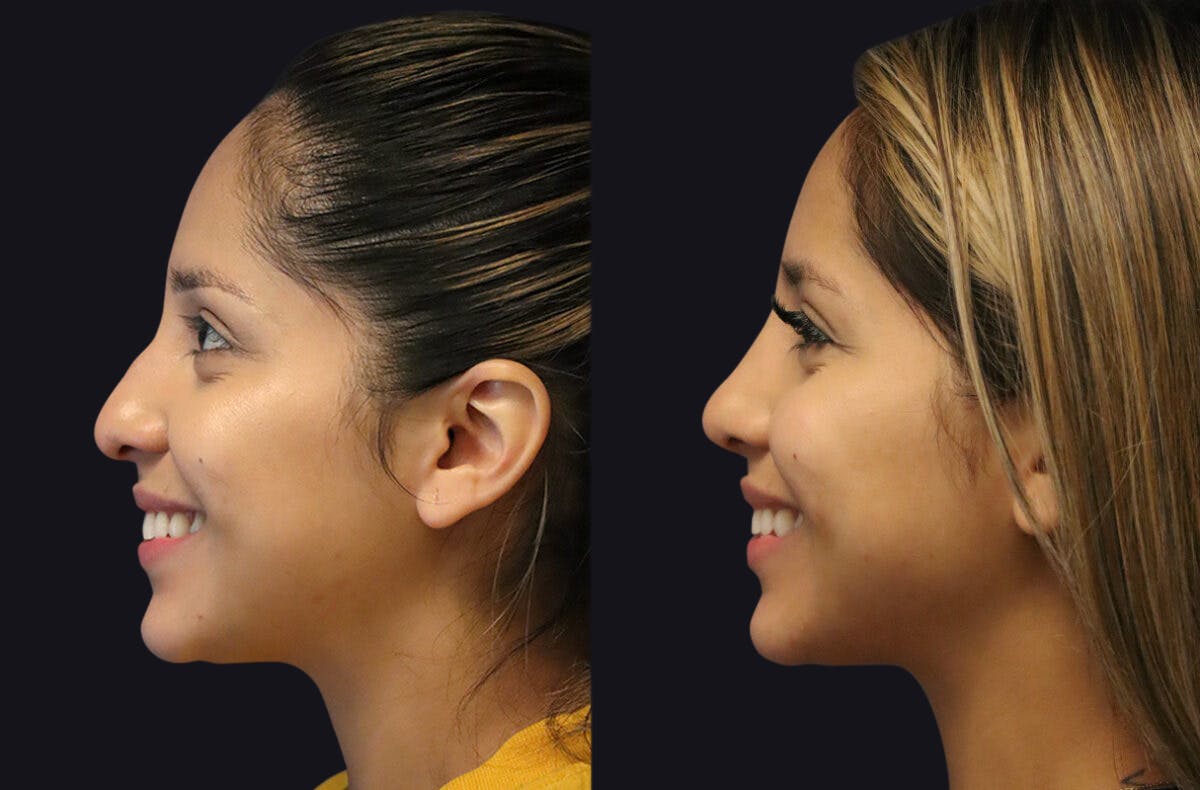 Rhinoplasty Before & After Gallery - Patient 177905934 - Image 7