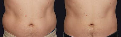 Male Coolsculpting Before & After Gallery - Patient 177905924 - Image 1