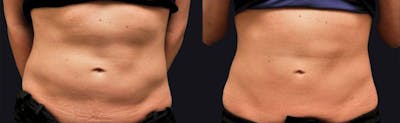 Coolsculpting Before & After Gallery - Patient 177905923 - Image 1