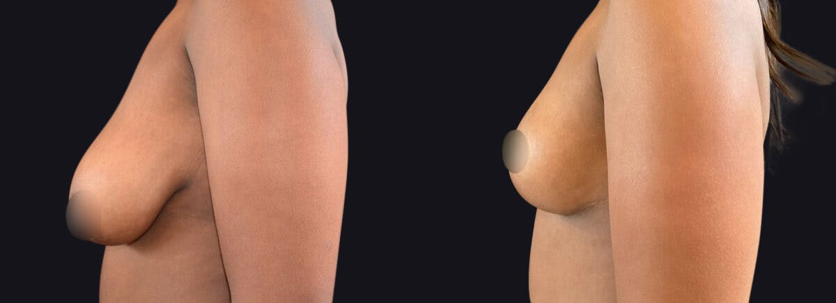 Breast Lift Before & After Gallery - Patient 177905922 - Image 3
