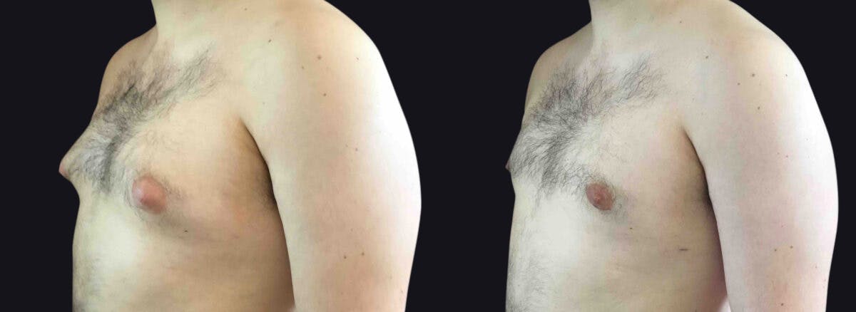 Male Breast Reduction (Gynecomastia) Before & After Gallery - Patient 177905921 - Image 3