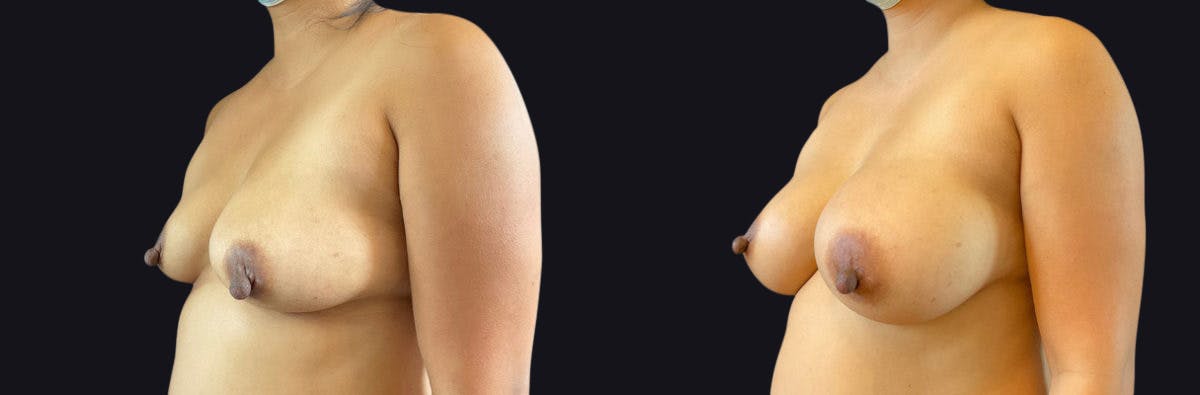 Breast Augmentation Before & After Gallery - Patient 177905920 - Image 3