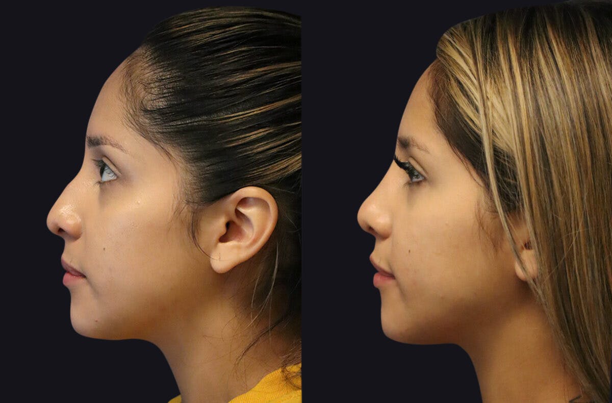 Rhinoplasty Before & After Gallery - Patient 177905934 - Image 6
