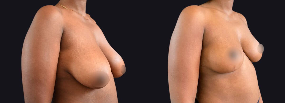 Breast Lift Before & After Gallery - Patient 177905922 - Image 2