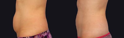 Coolsculpting Before & After Gallery - Patient 177905919 - Image 2