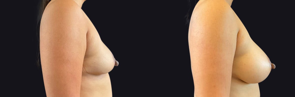 Breast Augmentation Before & After Gallery - Patient 177905920 - Image 2