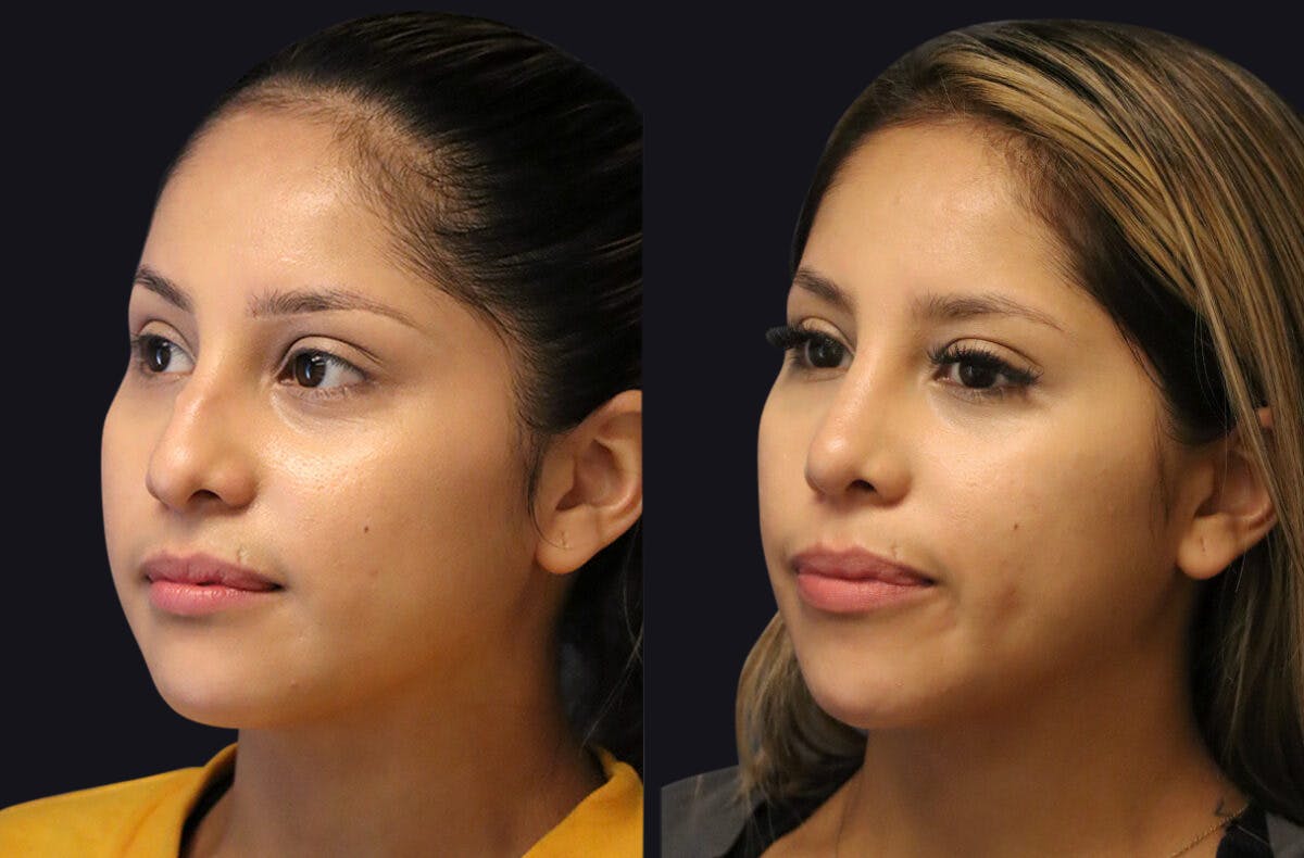 Rhinoplasty Before & After Gallery - Patient 177905934 - Image 5