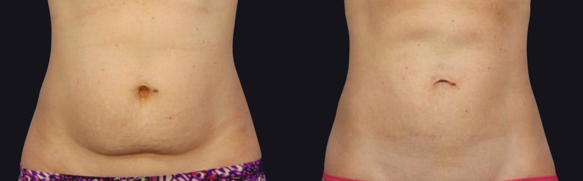 Coolsculpting Before & After Gallery - Patient 177905919 - Image 1