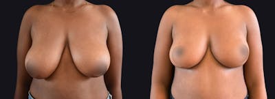 Breast Lift Before & After Gallery - Patient 177905922 - Image 1