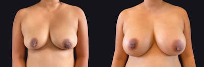 Breast Augmentation Before & After Gallery - Patient 177905920 - Image 1