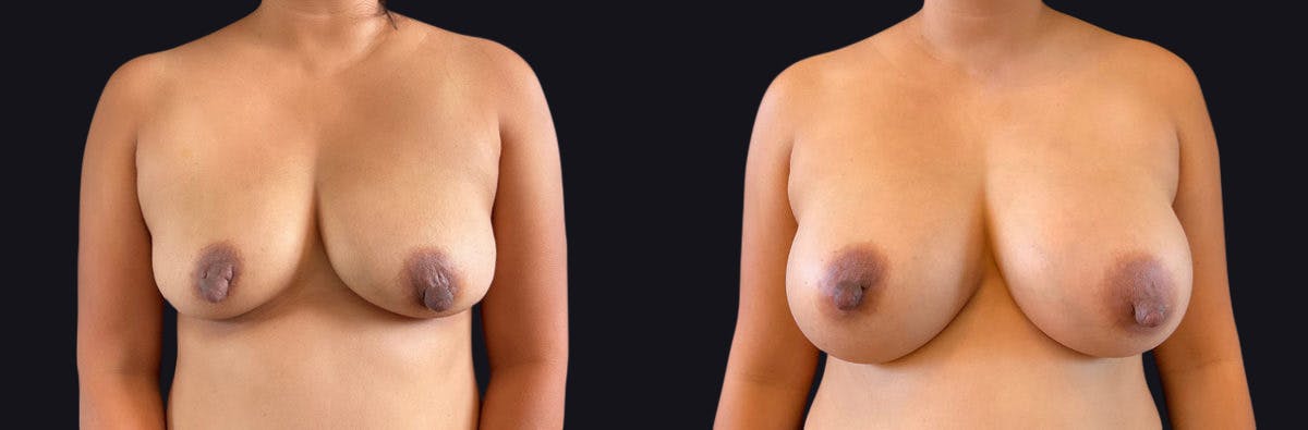Breast Augmentation Before & After Gallery - Patient 177905920 - Image 1