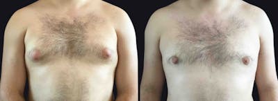 Male Breast Reduction Before & After Gallery - Patient 177905921 - Image 1