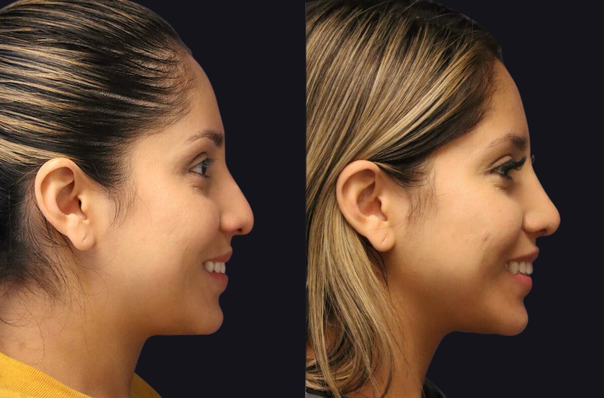 Rhinoplasty Before & After Gallery - Patient 177905934 - Image 4
