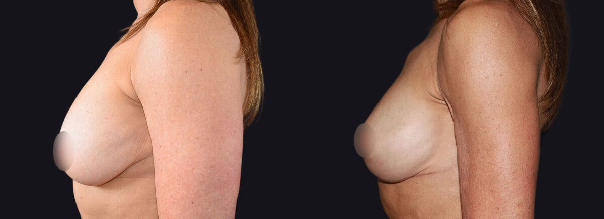 Breast Lift Before & After Gallery - Patient 177905914 - Image 3