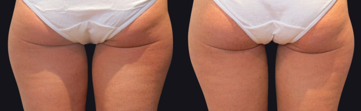 Coolsculpting Before & After Gallery - Patient 177905915 - Image 2
