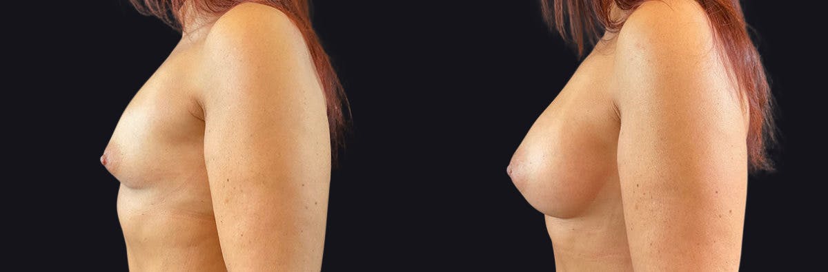 Breast Augmentation Before & After Gallery - Patient 177905910 - Image 3