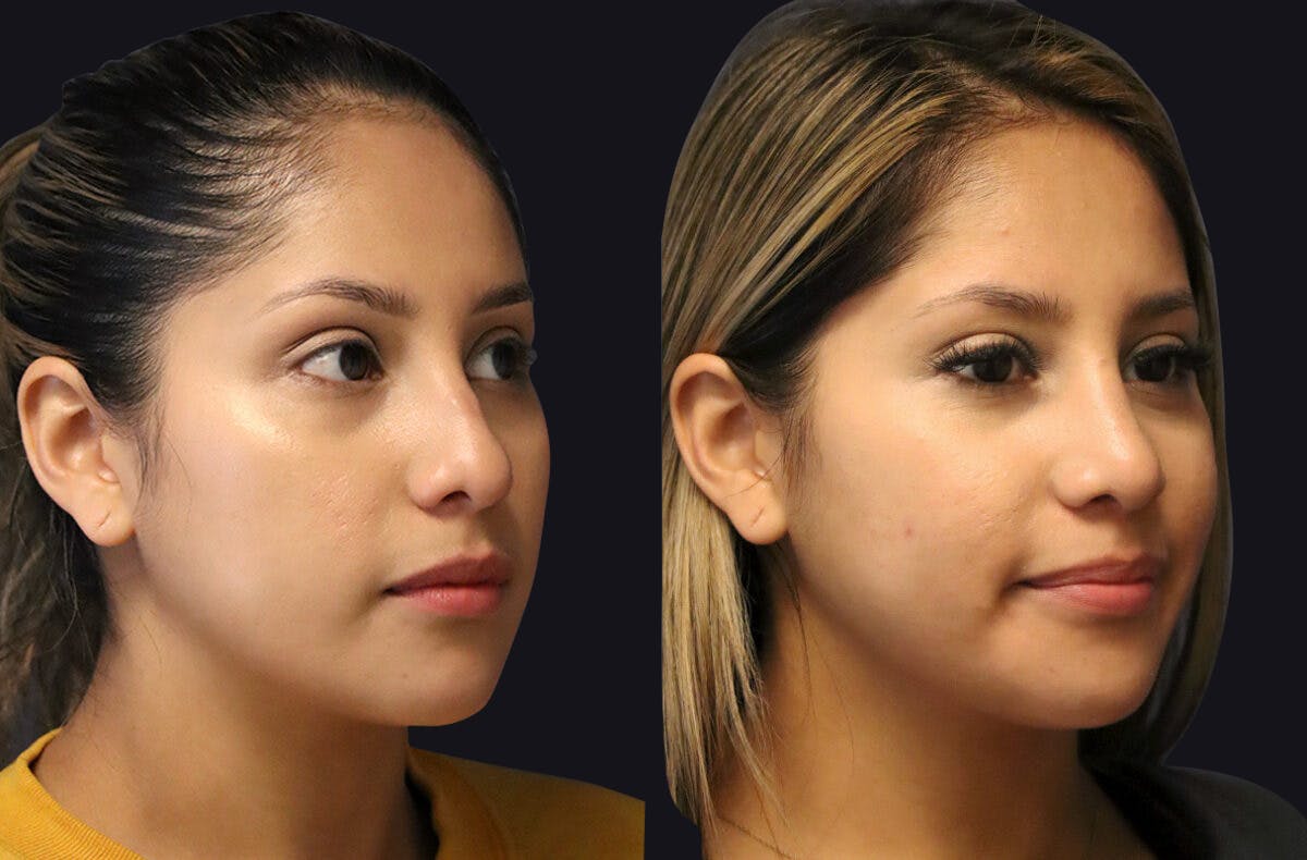 Rhinoplasty Before & After Gallery - Patient 177905934 - Image 3