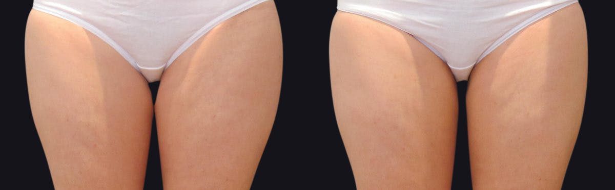 Coolsculpting Before & After Gallery - Patient 177905915 - Image 1