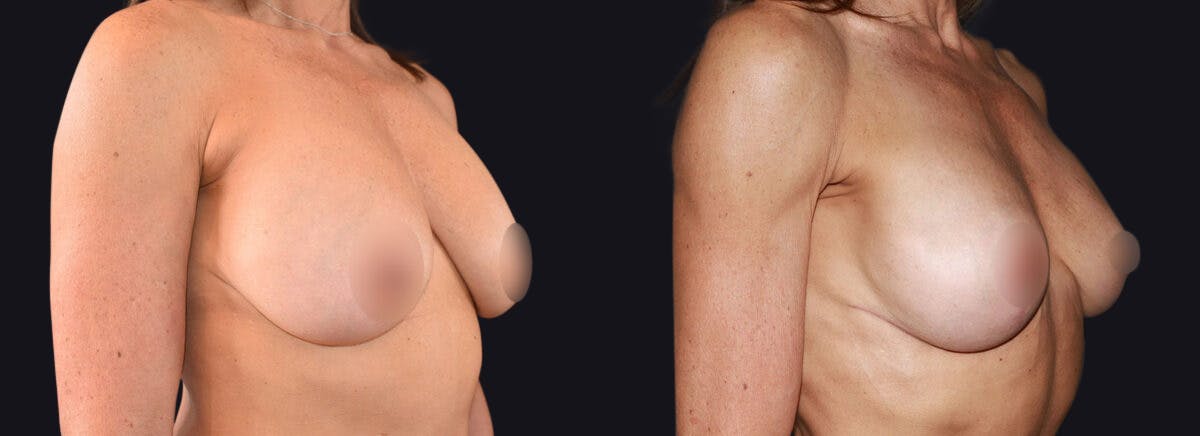 Breast Lift Before & After Gallery - Patient 177905914 - Image 2