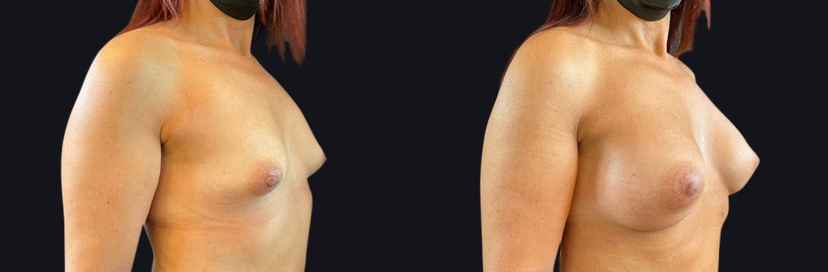 Breast Augmentation Before & After Gallery - Patient 177905910 - Image 2