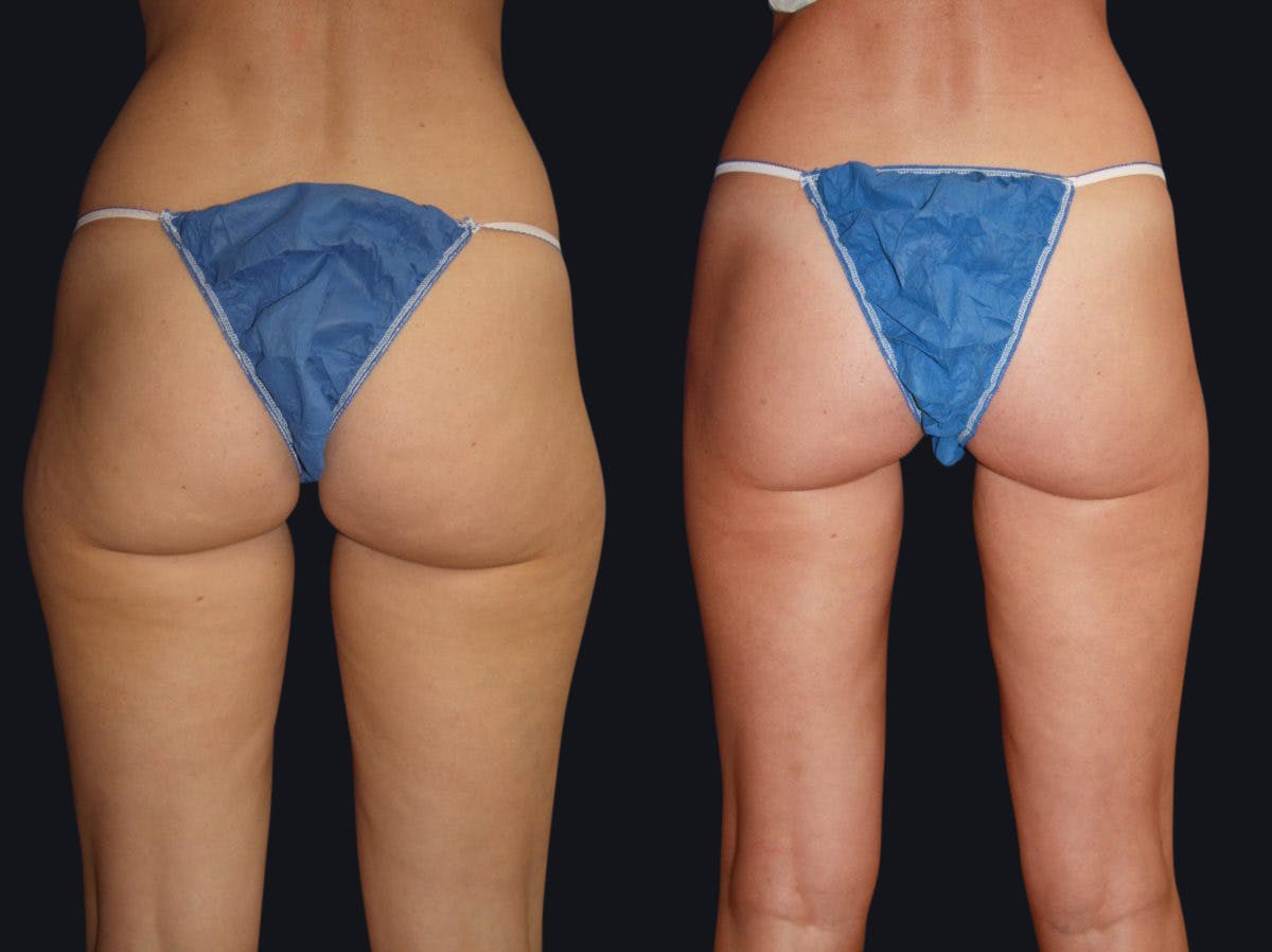 Liposuction Before & After Gallery - Patient 177905908 - Image 2