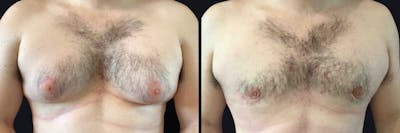 Male Breast Reduction Before & After Gallery - Patient 177905909 - Image 1