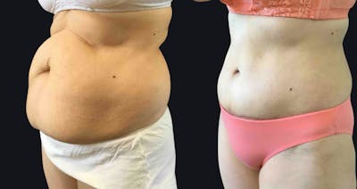 Abdominoplasty (Tummy Tuck) Before & After Gallery - Patient 177905907 - Image 2