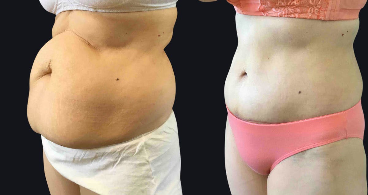 Abdominoplasty Before & After Gallery - Patient 177905907 - Image 2