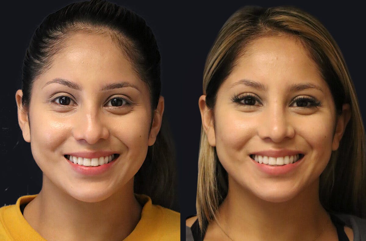 Rhinoplasty Before & After Gallery - Patient 177905934 - Image 2