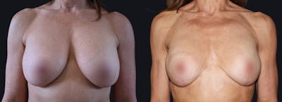 Breast Lift Before & After Gallery - Patient 177905914 - Image 1