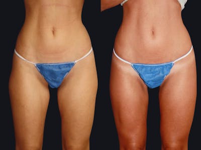 Liposuction Before & After Gallery - Patient 177905908 - Image 1