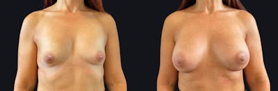 Breast Augmentation Before & After Gallery - Patient 177905910 - Image 1