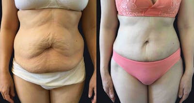 Abdominoplasty Before & After Gallery - Patient 177905907 - Image 1