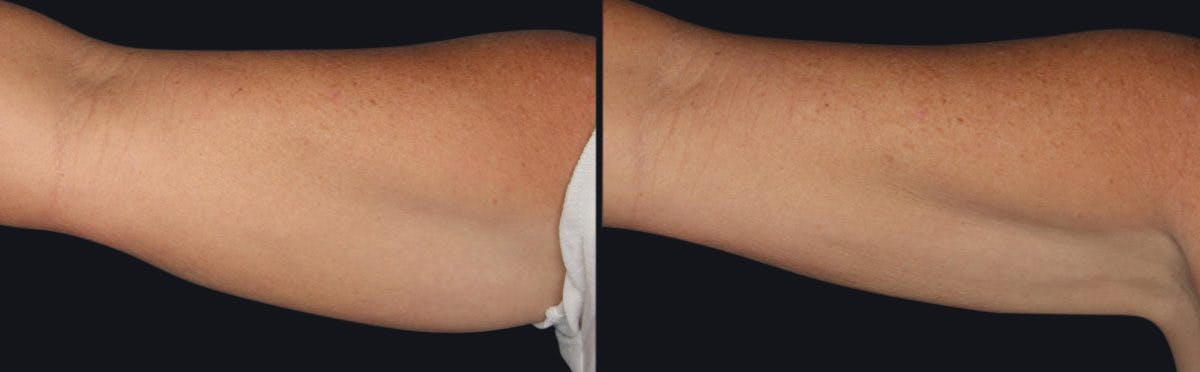 Coolsculpting Before & After Gallery - Patient 177905902 - Image 2
