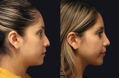 Rhinoplasty Before & After Gallery - Patient 177905934 - Image 1