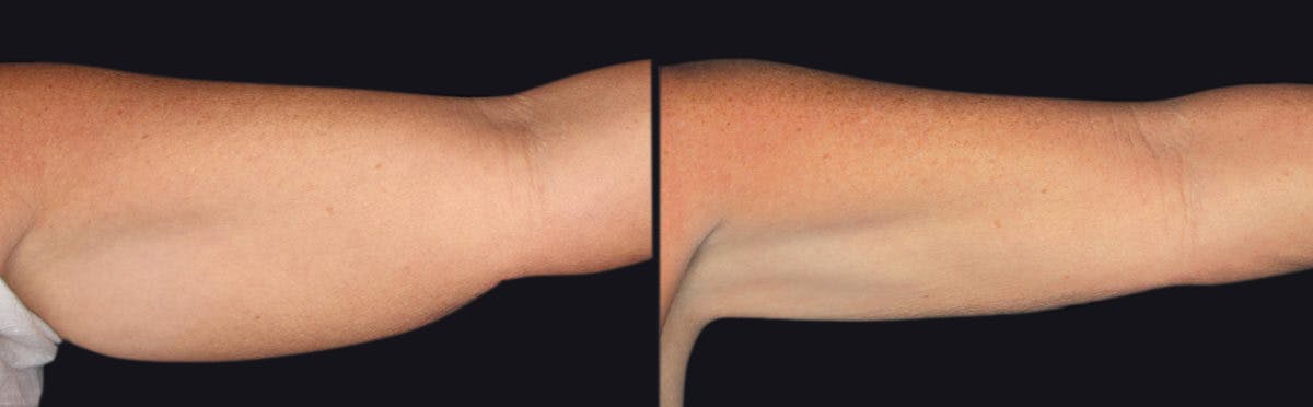 Coolsculpting Before & After Gallery - Patient 177905902 - Image 1