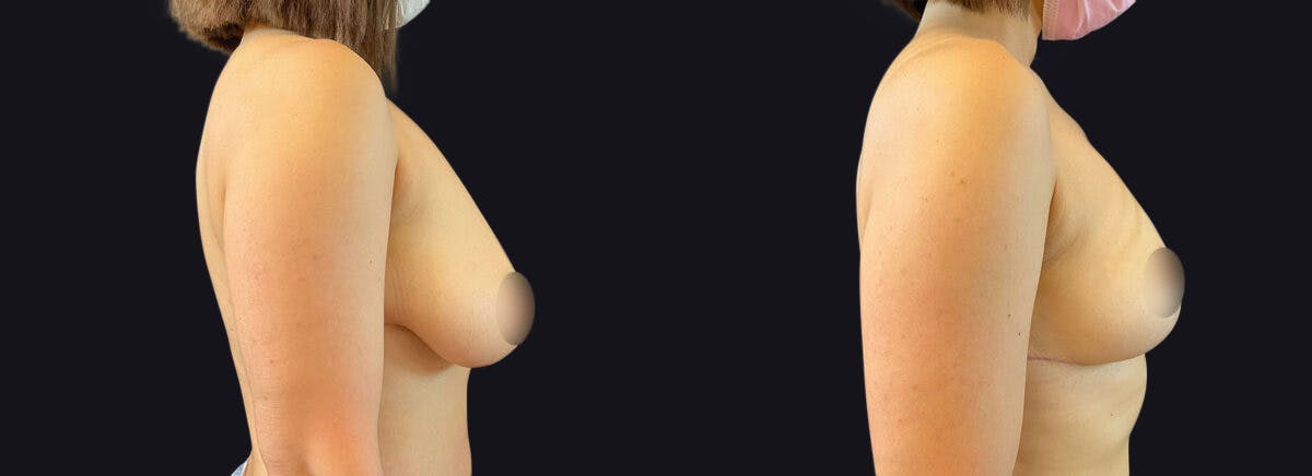 Breast Lift Before & After Gallery - Patient 177905898 - Image 3