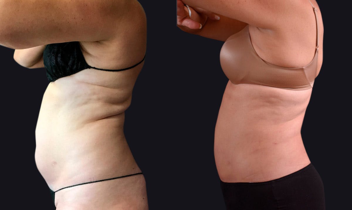 Liposuction Before & After Gallery - Patient 177905897 - Image 3