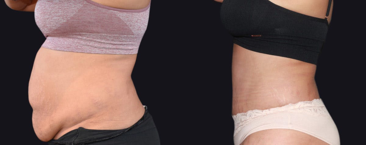 Abdominoplasty Before & After Gallery - Patient 177905896 - Image 3