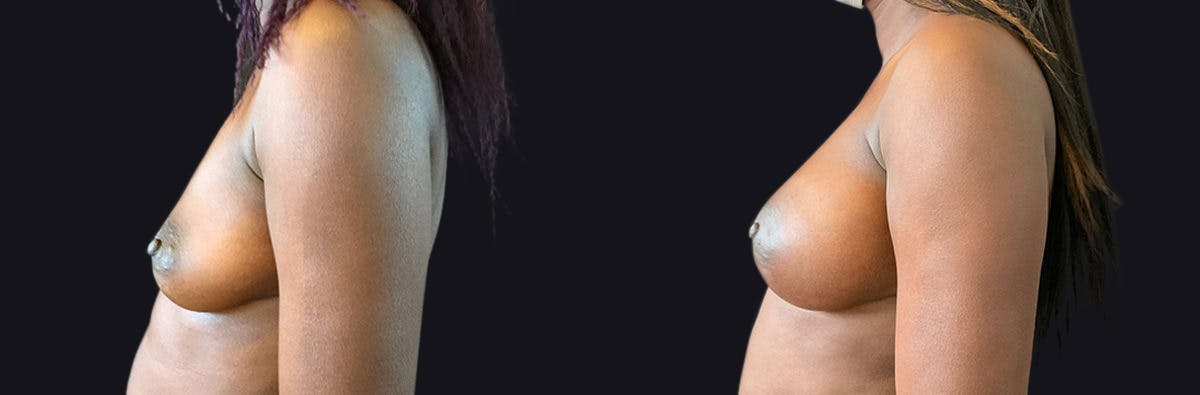 Breast Augmentation Before & After Gallery - Patient 177905895 - Image 3