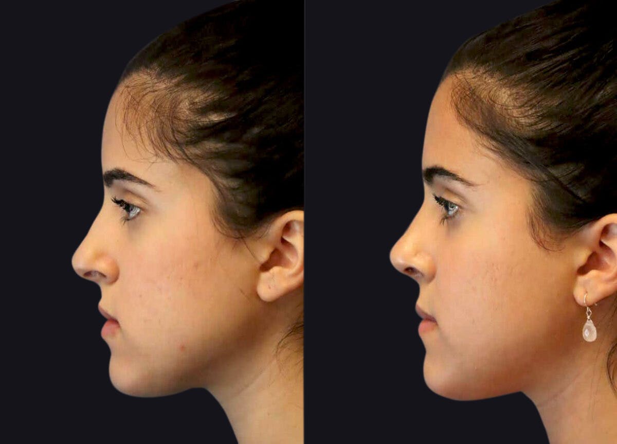 Rhinoplasty Before & After Gallery - Patient 195270 - Image 4