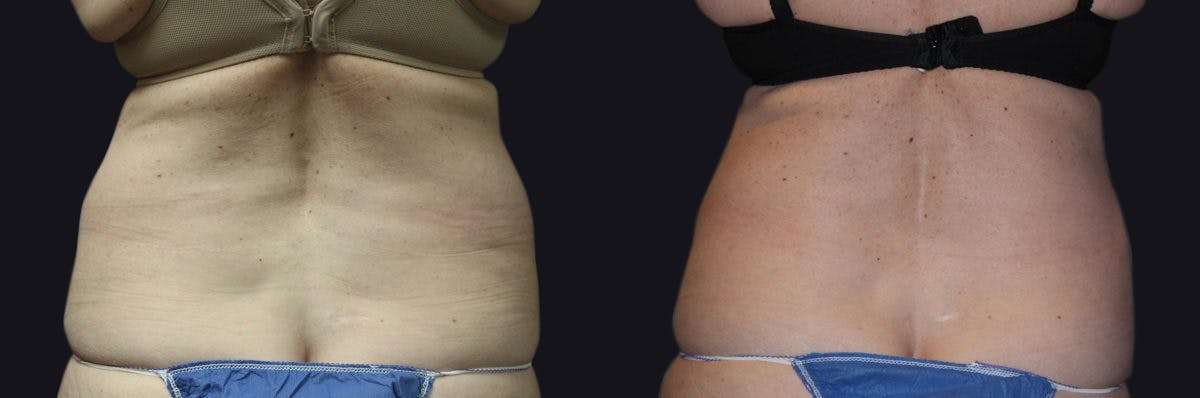 Coolsculpting Before & After Gallery - Patient 177905893 - Image 2