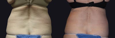 Coolsculpting Before & After Gallery - Patient 177905893 - Image 2