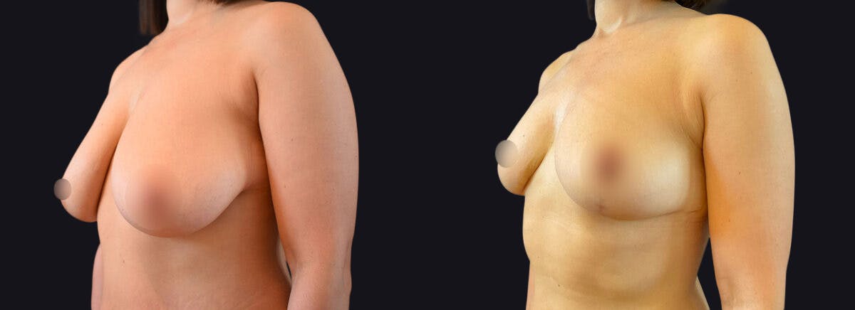 Breast Lift Before & After Gallery - Patient 177905898 - Image 2