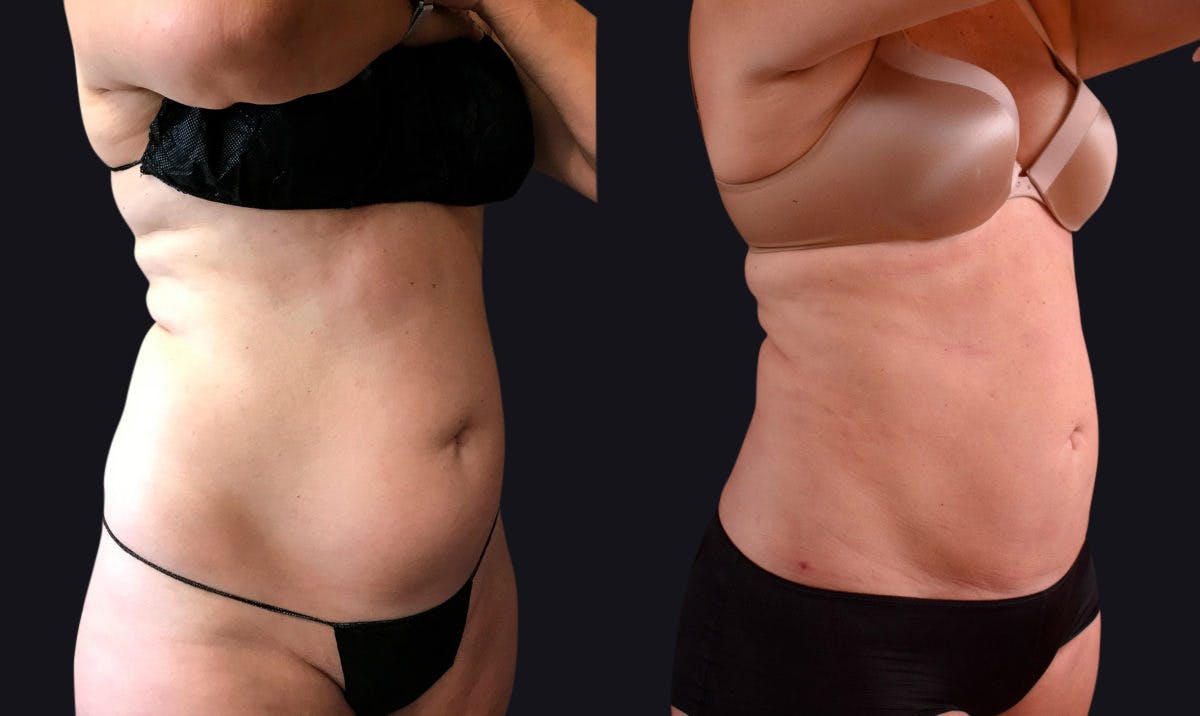 Liposuction Before & After Gallery - Patient 177905897 - Image 2